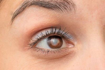 Penyebab dan Pengobatan Untuk Dermatitis Kelopak Mata di mata